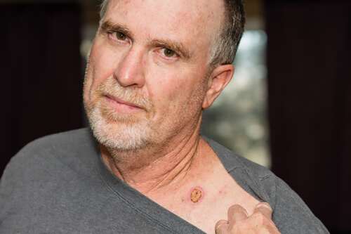 Skin Cancer