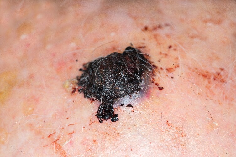Melanoma