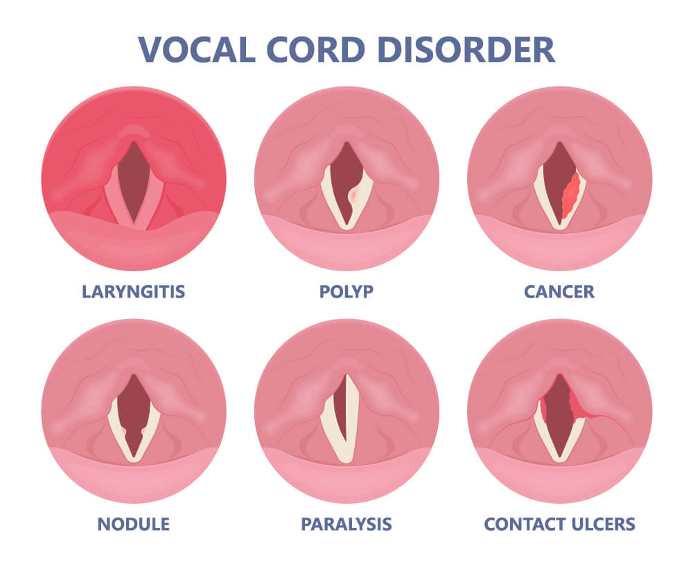 Voice Problems