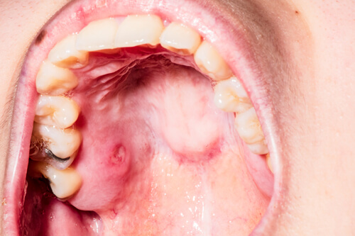 Mouth Lesions