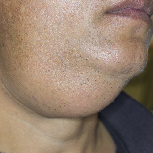 Neck Lumps