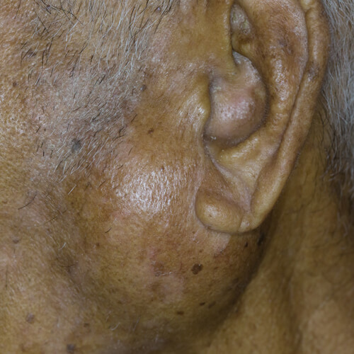 Parotid and Submandibular Salivary Gland Disease